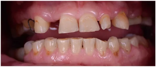 Before dental treatment